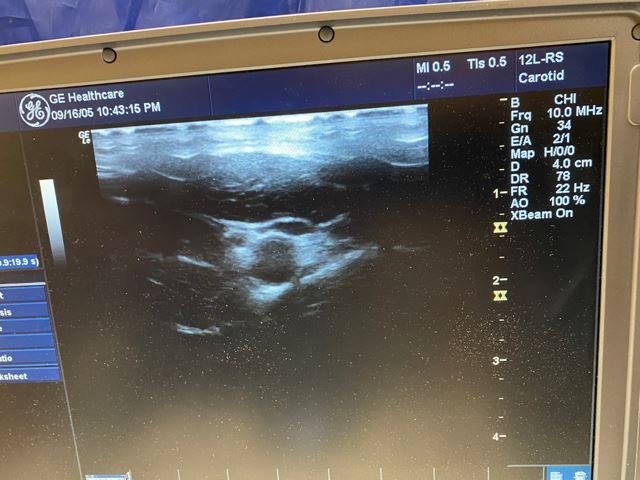 GE LOGIQ E Portable Ultrasound & phased array cardiac probe 6S-RS-Refurbished #