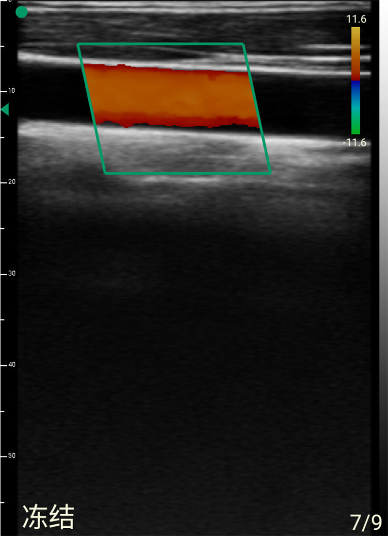 Global Healthcare Medical 2-in-1 palm doppler ultrasound scanner with dual-frequency linear array for point-of-care imaging