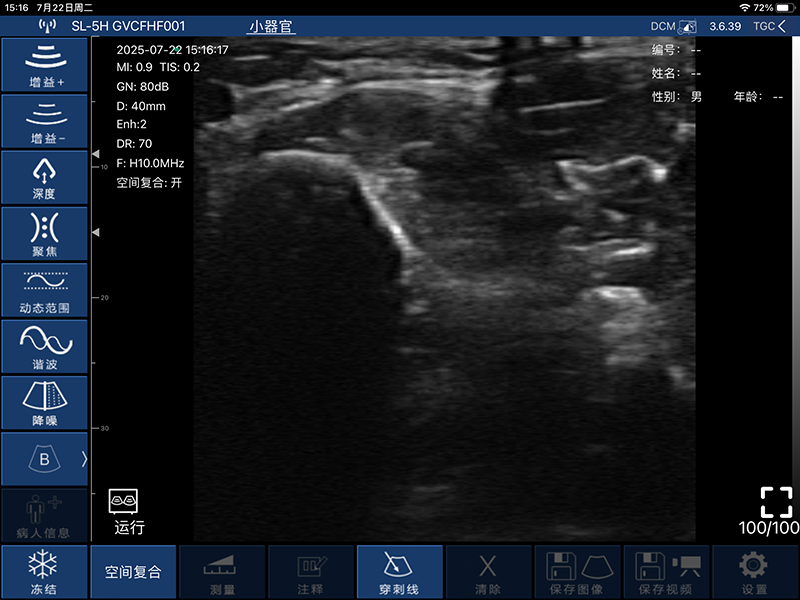 Global Healthcare Medical finger-sleeve probe handheld ultrasound scanner with 192-element linear array for hands-free imaging