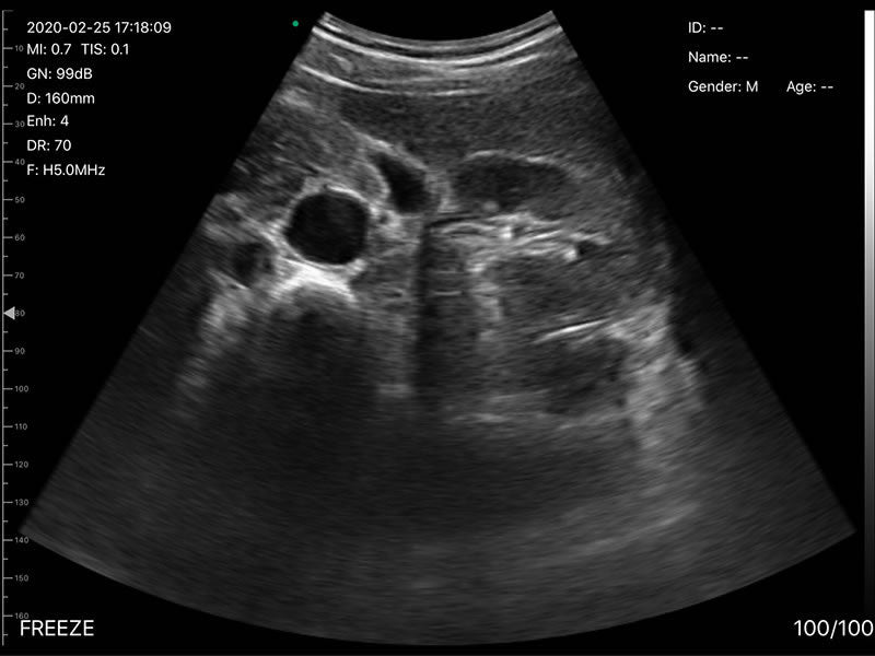 Global Healthcare Medical 3-in-1 palm doppler ultrasound scanner with convex, linear, and phased array probes for point-of-care imaging