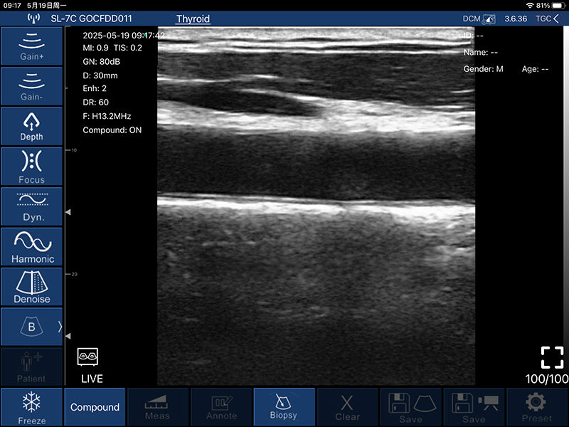 Global Healthcare Medical palm-sized wireless linear ultrasound scanner with 192-element probe for high-resolution superficial imaging