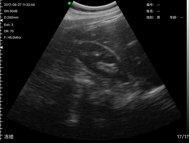 Global Healthcare Medical wireless handheld convex array ultrasound system for abdominal and point-of-care imaging