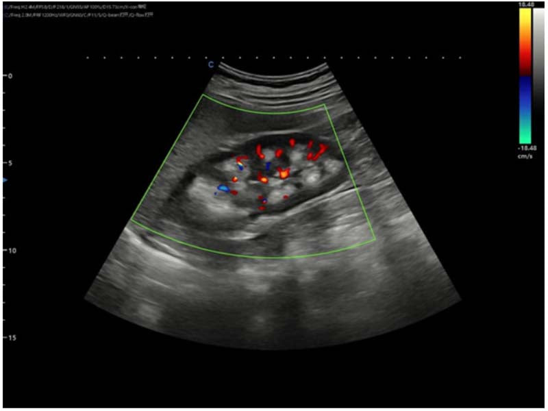 Ultrasound imaging used to evaluate medullary sponge kidneys