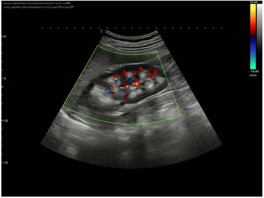 Ultrasound imaging used to evaluate medullary sponge kidneys