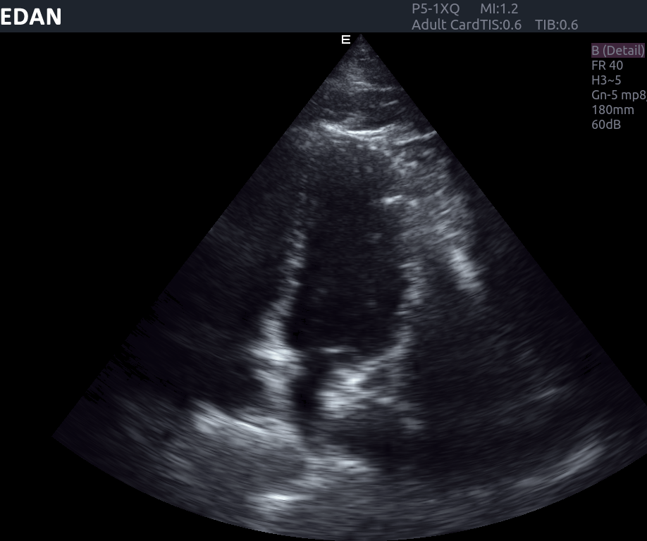 EDAN Acclarix AX8 Diagnostic Ultrasound System