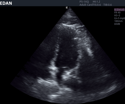EDAN Acclarix AX8 Diagnostic Ultrasound System