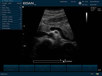 EDAN U2 Diagnostic Ultrasound System