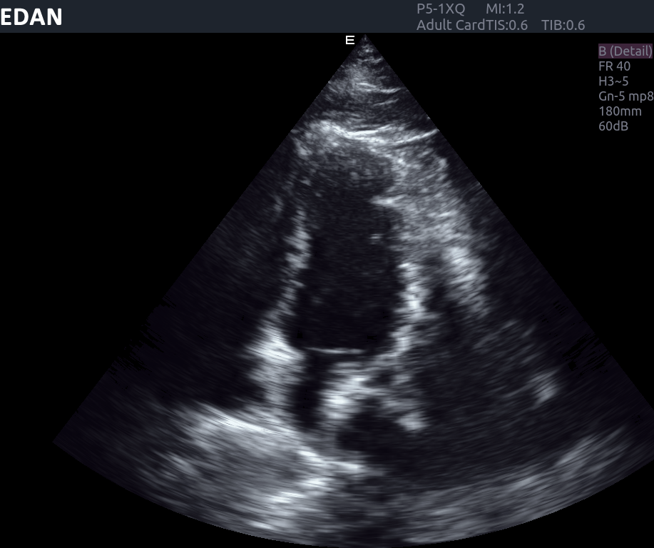 EDAN Acclarix AX8 Diagnostic Ultrasound System