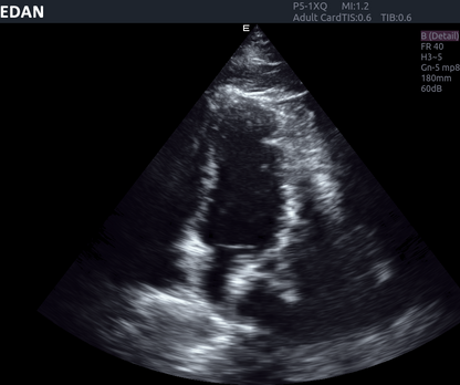 EDAN Acclarix AX8 Diagnostic Ultrasound System