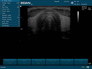 EDAN U2 Diagnostic Ultrasound System