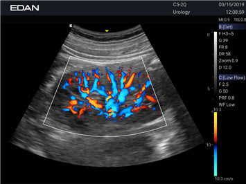 EDAN Acclarix LX3 Diagnostic Ultrasound System