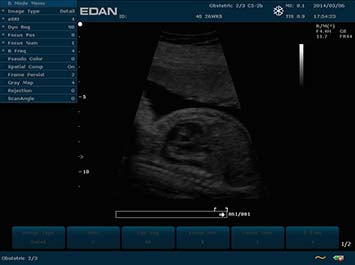 EDAN U2 Diagnostic Ultrasound System