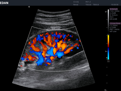 EDAN Acclarix AX8 Diagnostic Ultrasound System