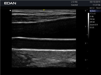 EDAN Acclarix LX3 Diagnostic Ultrasound System