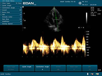 EDAN U2 Diagnostic Ultrasound System