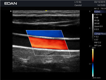 EDAN Acclarix LX3 Diagnostic Ultrasound System