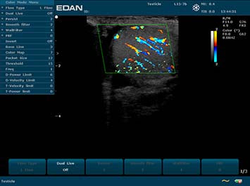 EDAN U2 Diagnostic Ultrasound System