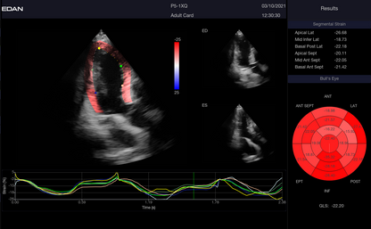 EDAN Acclarix LX9 Diagnostic Ultrasound System