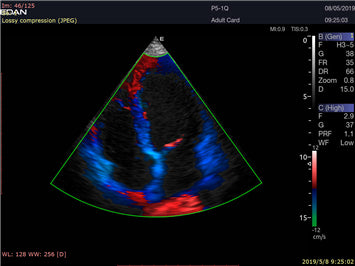 EDAN Acclarix LX9 Diagnostic Ultrasound System