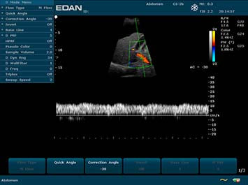EDAN U2 Diagnostic Ultrasound System