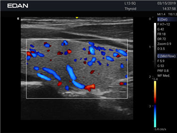 EDAN Acclarix LX3 Diagnostic Ultrasound System