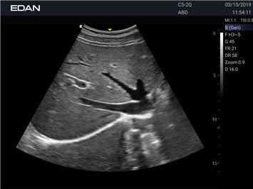 EDAN Acclarix LX3 Diagnostic Ultrasound System