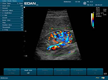 EDAN U2 Diagnostic Ultrasound System