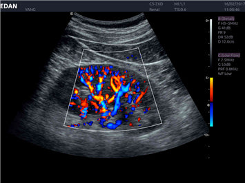 EDAN Acclarix AX8 Diagnostic Ultrasound System