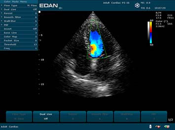 EDAN U2 Diagnostic Ultrasound System
