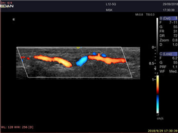 EDAN Acclarix LX9 Diagnostic Ultrasound System