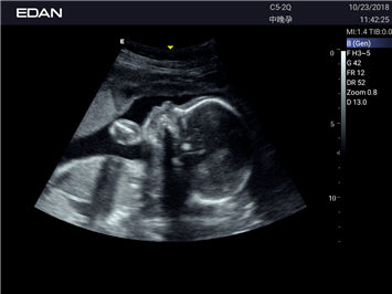EDAN Acclarix LX3 Diagnostic Ultrasound System