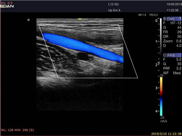 EDAN Acclarix LX9 Diagnostic Ultrasound System