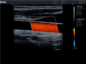 EDAN Acclarix AX8 Diagnostic Ultrasound System