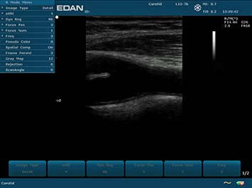 EDAN U2 Diagnostic Ultrasound System