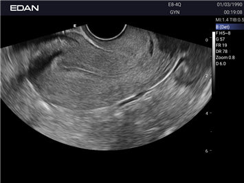 EDAN Acclarix LX3 Diagnostic Ultrasound System