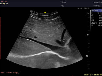 EDAN Acclarix LX9 Diagnostic Ultrasound System