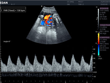 EDAN Acclarix AX8 Diagnostic Ultrasound System