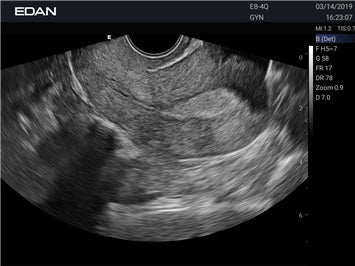 EDAN Acclarix LX3 Diagnostic Ultrasound System