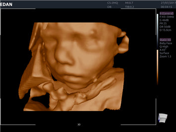 EDAN Acclarix AX8 Diagnostic Ultrasound System