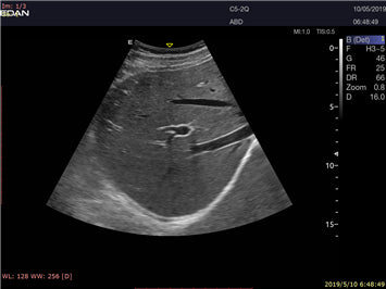 EDAN Acclarix LX9 Diagnostic Ultrasound System