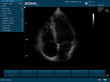 EDAN U2 Diagnostic Ultrasound System