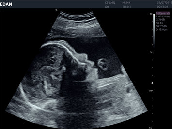 EDAN Acclarix AX8 Diagnostic Ultrasound System