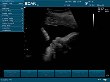 EDAN U2 Diagnostic Ultrasound System