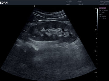 EDAN Acclarix AX8 Diagnostic Ultrasound System