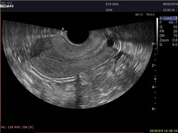 EDAN Acclarix LX9 Diagnostic Ultrasound System
