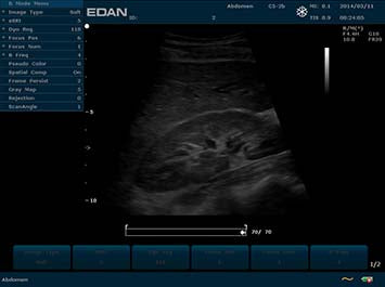 EDAN U2 Diagnostic Ultrasound System