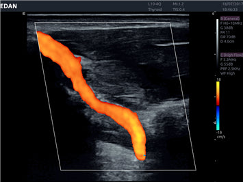 EDAN Acclarix AX8 Diagnostic Ultrasound System