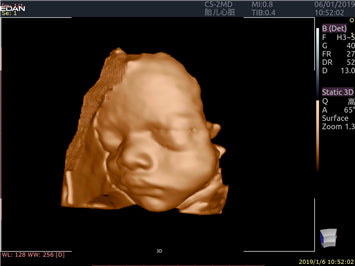 EDAN Acclarix LX9 Diagnostic Ultrasound System
