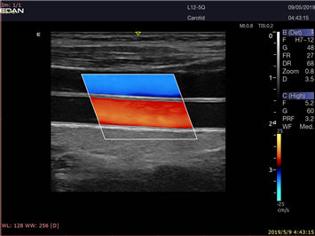 EDAN Acclarix LX9 Diagnostic Ultrasound System
