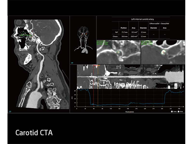 Neusoft NeuViz ACE 64e CT